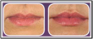 Dr Rita Rakus - Before and After Lip treatment with Juvederm